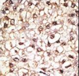 Formalin-fixed and paraffin-embedded human cancer tissue reacted with the primary antibody, which was peroxidase-conjugated to the secondary antibody, followed by AEC staining. This data demonstrates the use of this antibody for immunohistochemistry; clinical relevance has not been evaluated. BC = breast carcinoma; HC = hepatocarcinoma.