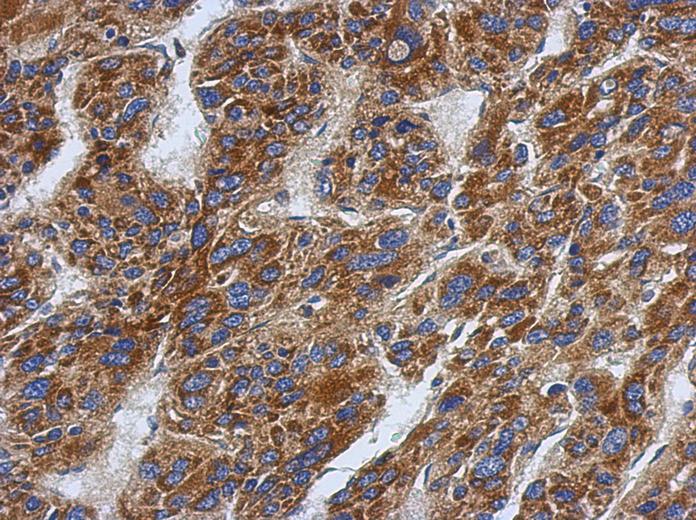 IHC of paraffin-embedded Hepatoma, using SFXN1 antibody antibody at 1:500 dilution.