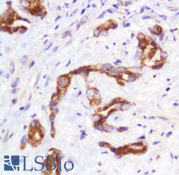 Immunohistochemistry of Human Prostate Carcinoma stained with anti-SLIT2 antibody