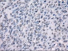 IHC of paraffin-embedded Carcinoma of bladder tissue using anti-SSX2 mouse monoclonal antibody. (Dilution 1:50).