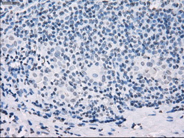 IHC of paraffin-embedded Carcinoma of thyroid tissue using anti-SSX2 mouse monoclonal antibody. (Dilution 1:50).