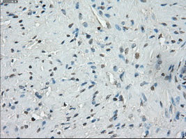 IHC of paraffin-embedded prostate tissue using anti-SSX2 mouse monoclonal antibody. (Dilution 1:50).