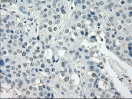 IHC of paraffin-embedded Adenocarcinoma of breast tissue using anti-SSX2 mouse monoclonal antibody. (Dilution 1:50).