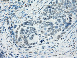 IHC of paraffin-embedded Adenocarcinoma of ovary tissue using anti-SSX2 mouse monoclonal antibody. (Dilution 1:50).