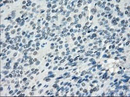 IHC of paraffin-embedded Carcinoma of bladder tissue using anti-SSX2 mouse monoclonal antibody. (Dilution 1:50).