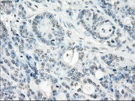 IHC of paraffin-embedded Adenocarcinoma of colon tissue using anti-SSX2 mouse monoclonal antibody. (Dilution 1:50).