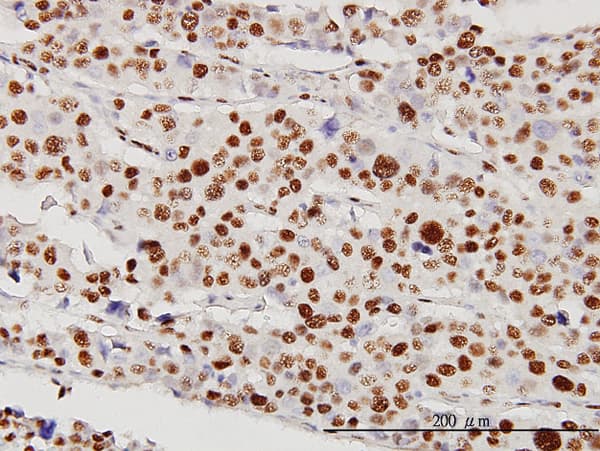 Immunoperoxidase of monoclonal antibody to STK38 on formalin-fixed paraffin-embedded human malignant lymphoma, diffuse large B tissue [antibody concentration 5 ug/ml].