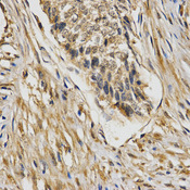 Immunohistochemistry of paraffin-embedded human esophageal cancer using STXBP1 antibody at dilution of 1:200 (x400 lens).