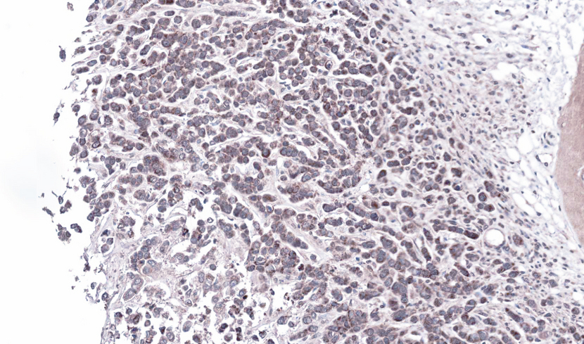 IHC of paraffin-embedded Breast CA using STYK1 antibody at 1:100 dilution.