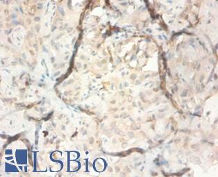 Immunohistochemistry of paraffin-embedded human liver cancer using SERPINB3 / SCC antibody at dilution 1:100.