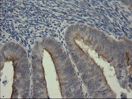 IHC of paraffin-embedded Adenocarcinoma of Human endometrium tissue using anti-SERPINB3 mouse monoclonal antibody.