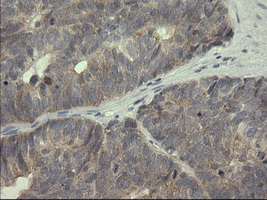 IHC of paraffin-embedded Adenocarcinoma of Human ovary tissue using anti-SERPINB3 mouse monoclonal antibody.