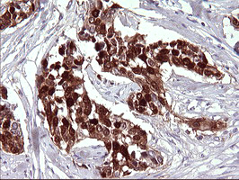 IHC of paraffin-embedded Carcinoma of Human bladder tissue using anti-SERPINB3 mouse monoclonal antibody. (Heat-induced epitope retrieval by 10mM citric buffer, pH6.0, 120°C for 3min).