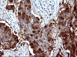 IHC of paraffin-embedded Carcinoma of Human lung tissue using anti-SERPINB3 mouse monoclonal antibody. (Heat-induced epitope retrieval by 10mM citric buffer, pH6.0, 120°C for 3min).
