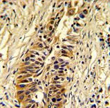 Formalin-fixed and paraffin-embedded human lung carcinoma reacted with TALDO1 Antibody , which was peroxidase-conjugated to the secondary antibody, followed by DAB staining. This data demonstrates the use of this antibody for immunohistochemistry; clinical relevance has not been evaluated.
