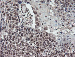 IHC of paraffin-embedded Carcinoma of Human lung tissue using anti-TDO2 mouse monoclonal antibody.