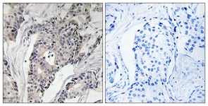 IHC of paraffin-embedded human breast carcinoma, using THBS4 Antibody. The sample on the right was incubated with synthetic peptide.