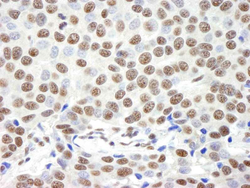 Detection of Human Timeless by Immunohistochemistry. Sample: FFPE section of human breast carcinoma. Antibody: Affinity purified rabbit anti-Timeless used at a dilution of 1:250.