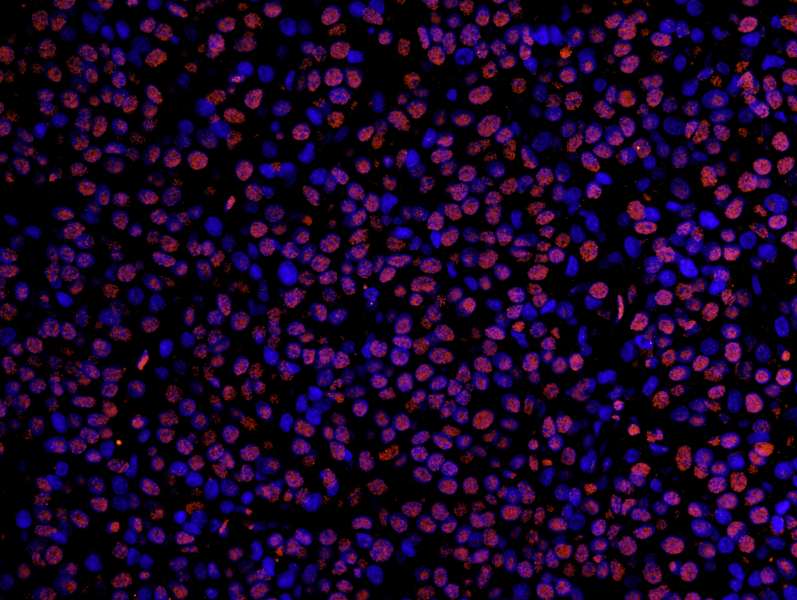 Detection of Human Timeless by Immunofluorescence. Sample: FFPE section of human breast carcinoma. Antibody: Affinity purified rabbit anti-Timeless used at a dilution of 1:100. Detection: Red-fluorescent Alexa Fluor 555 goat anti-rabbit IgG (Invitrogen) used at a dilution of 1:500.