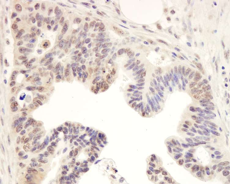 Detection of Human Timeless by Immunohistochemistry. Sample: FFPE section of human ovarian carcinoma. Antibody: Affinity purified rabbit anti-Timeless used at a dilution of 1:1000 (1 ug/ml). Detection: DAB.