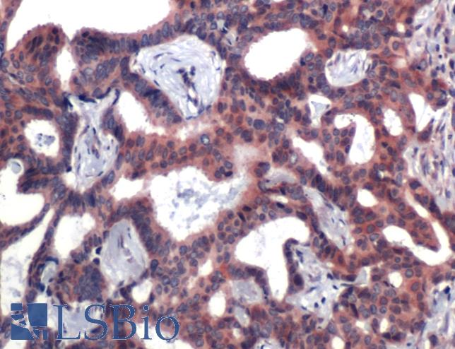 Human, Breast carcinoma: Formalin-Fixed, Paraffin-Embedded (FFPE)