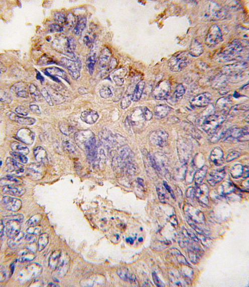 Formalin-fixed and paraffin-embedded human colon carcinoma tissue reacted with TRAF2 antibody , which was peroxidase-conjugated to the secondary antibody, followed by DAB staining. This data demonstrates the use of this antibody for immunohistochemistry; clinical relevance has not been evaluated.