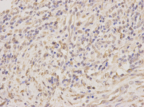 Immunohistochemistry of paraffin-embedded human stomach cancer using TNFRSF10D antibody at dilution of 1:200 (400x lens).