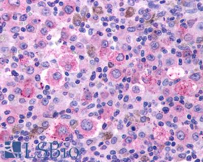 Anti-TBXA2R / Thromboxane Receptor antibody IHC of human Skin, Melanoma. Immunohistochemistry of formalin-fixed, paraffin-embedded tissue after heat-induced antigen retrieval.