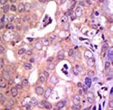 Formalin-fixed and paraffin-embedded human cancer tissue reacted with the primary antibody, which was peroxidase-conjugated to the secondary antibody, followed by AEC staining. This data demonstrates the use of this antibody for immunohistochemistry; clinical relevance has not been evaluated. BC = breast carcinoma; HC = hepatocarcinoma.