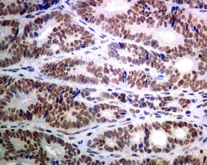 IHC of paraffin-embedded human colonic adenocarcinoma tissue using anti-USP39 antibody.