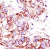 Formalin-fixed and paraffin-embedded human cancer tissue reacted with the primary antibody, which was peroxidase-conjugated to the secondary antibody, followed by AEC staining. This data demonstrates the use of this antibody for immunohistochemistry; clinical relevance has not been evaluated. BC = breast carcinoma; HC = hepatocarcinoma.