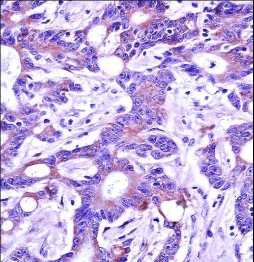 USP4 Antibody immunohistochemistry of formalin-fixed and paraffin-embedded human colon carcinoma followed by peroxidase-conjugated secondary antibody and DAB staining.