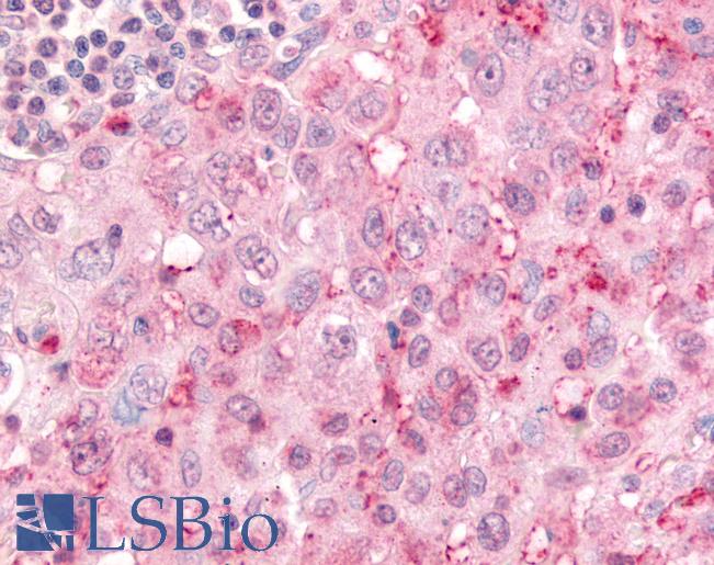 Anti-USP4 / UNP antibody IHC of human Lung, Non-Small Cell Carcinoma. Immunohistochemistry of formalin-fixed, paraffin-embedded tissue after heat-induced antigen retrieval.