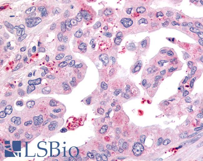 Anti-USP4 / UNP antibody IHC of human Pancreas, Carcinoma. Immunohistochemistry of formalin-fixed, paraffin-embedded tissue after heat-induced antigen retrieval.