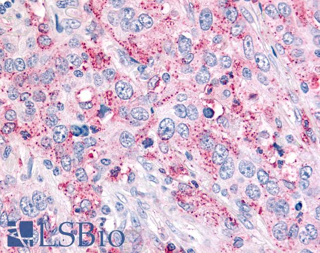 Anti-USP4 / UNP antibody IHC of human Lung, Non-Small Cell Carcinoma. Immunohistochemistry of formalin-fixed, paraffin-embedded tissue after heat-induced antigen retrieval.