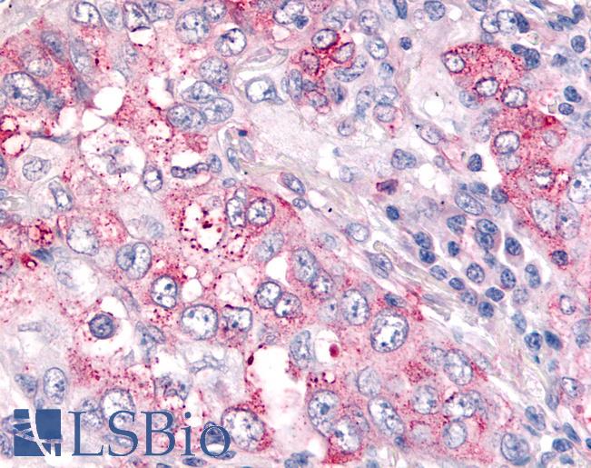 Anti-USP4 / UNP antibody IHC of human Lung, Non-Small Cell Carcinoma. Immunohistochemistry of formalin-fixed, paraffin-embedded tissue after heat-induced antigen retrieval.