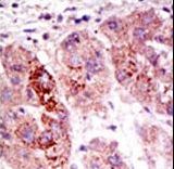 Formalin-fixed and paraffin-embedded human cancer tissue reacted with the primary antibody, which was peroxidase-conjugated to the secondary antibody, followed by AEC staining. This data demonstrates the use of this antibody for immunohistochemistry; clinical relevance has not been evaluated. BC = breast carcinoma; HC = hepatocarcinoma.