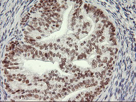 IHC of paraffin-embedded Adenocarcinoma of Human endometrium tissue using anti-USP7 mouse monoclonal antibody.