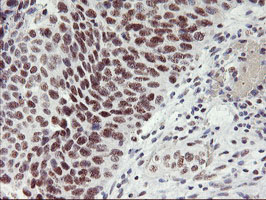 IHC of paraffin-embedded Carcinoma of Human bladder tissue using anti-USP7 mouse monoclonal antibody.