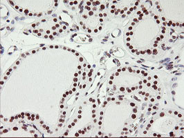 IHC of paraffin-embedded Carcinoma of Human thyroid tissue using anti-USP7 mouse monoclonal antibody.
