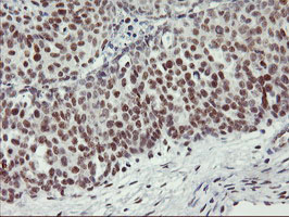 IHC of paraffin-embedded Adenocarcinoma of Human ovary tissue using anti-USP7 mouse monoclonal antibody.