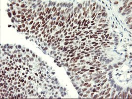IHC of paraffin-embedded Carcinoma of Human bladder tissue using anti-USP7 mouse monoclonal antibody. (Heat-induced epitope retrieval by 10mM citric buffer, pH6.0, 100C for 10min).
