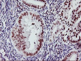 IHC of paraffin-embedded Adenocarcinoma of Human endometrium tissue using anti-USP7 mouse monoclonal antibody. (Heat-induced epitope retrieval by 10mM citric buffer, pH6.0, 100C for 10min).