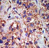 Formalin-fixed and paraffin-embedded human cancer tissue reacted with the primary antibody, which was peroxidase-conjugated to the secondary antibody, followed by DAB staining. This data demonstrates the use of this antibody for immunohistochemistry; clinical relevance has not been evaluated. BC = breast carcinoma; HC = hepatocarcinoma.