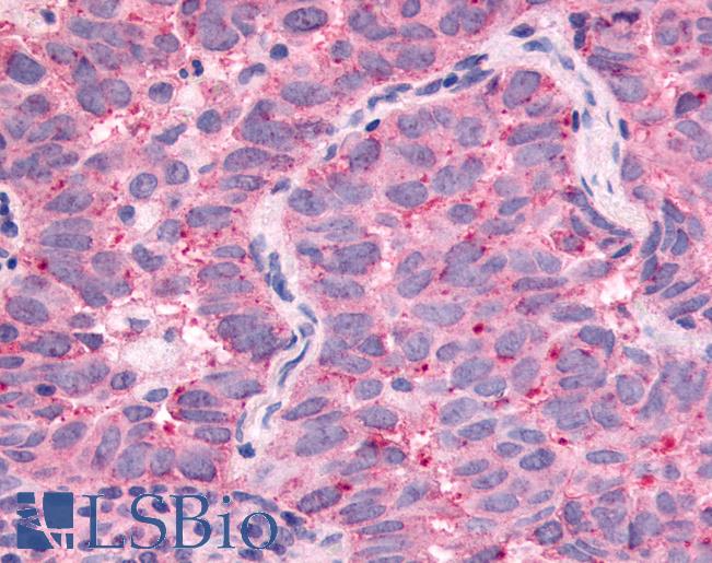 Anti-WNK1 / p65 antibody IHC of human Lung, Non-Small Cell Carcinoma. Immunohistochemistry of formalin-fixed, paraffin-embedded tissue after heat-induced antigen retrieval.