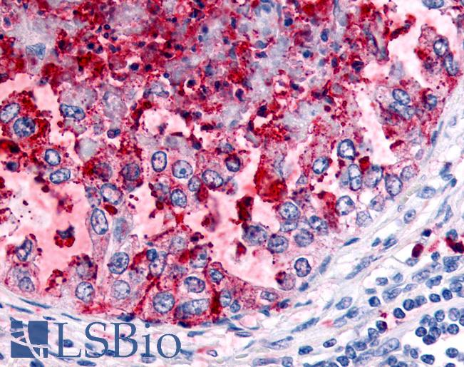 Anti-WNK1 / p65 antibody IHC of human Lung, Non-Small Cell Carcinoma. Immunohistochemistry of formalin-fixed, paraffin-embedded tissue after heat-induced antigen retrieval.