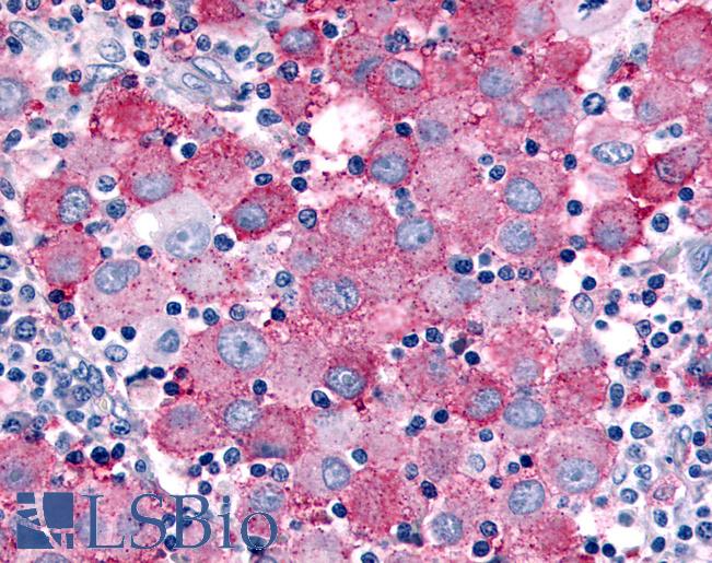 Anti-WNK1 / p65 antibody IHC of human Skin, Melanoma. Immunohistochemistry of formalin-fixed, paraffin-embedded tissue after heat-induced antigen retrieval.