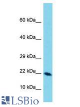 DEFB129 antibody Western Blot of Esophagus Tumor. Antibody dilution: 1 ug/ml.