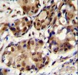 PELP1 Antibody (Center R759) immunohistochemistry of formalin-fixed and paraffin-embedded human breast carcinoma followed by peroxidase-conjugated secondary antibody and DAB staining.