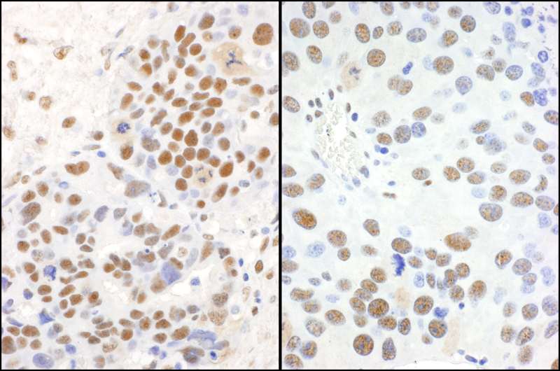 Detection of Human and Mouse PELP1/MNAR by Immunohistochemistry. Sample: FFPE sections of human ovarian carcinoma (left) and mouse renal cell carcinoma (right). Antibody: Affinity purified rabbit anti-PELP1/MNAR used at a dilution of 1:5000 (0.2 ug/ml) and 1:1000 (1 ug/ml). Detection: DAB.